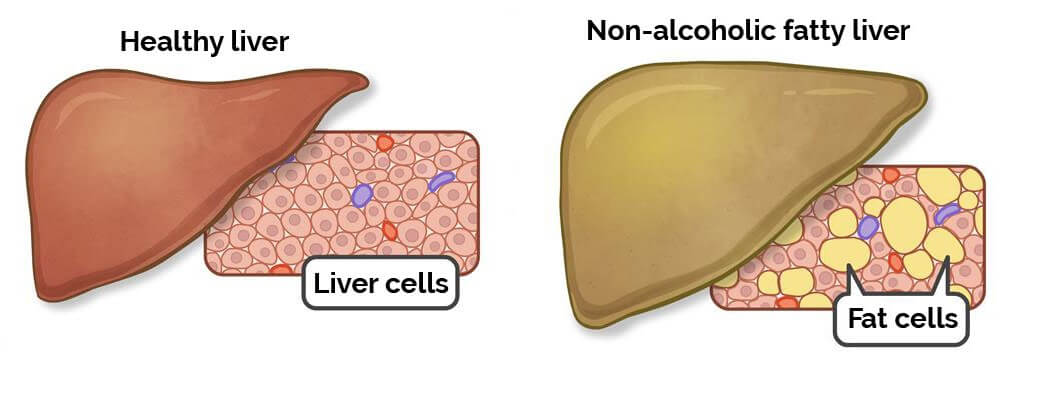 Non-Alcoholic Fatty Liver Disease Symptoms | NAFLD | Request A Test